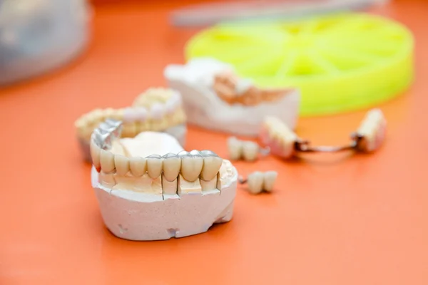 Denti metalo-acrilici — Foto Stock
