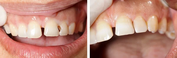 Tratamento de enchimento dentário — Fotografia de Stock