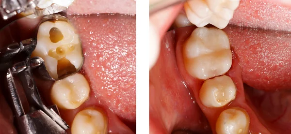 Wypełnianie zębów przez dentystę Zdjęcie Stockowe