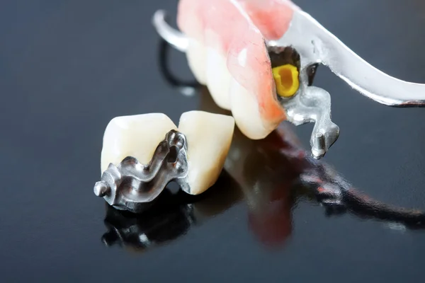 Dental prosthesis — Stock Photo, Image