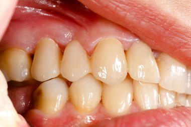 oral kavite içinde seramik diş preslenmiş
