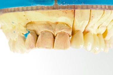 Pressed ceramic teeth clipart