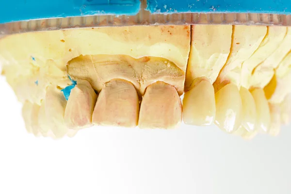 Pressed ceramic teeth — Stock Photo, Image