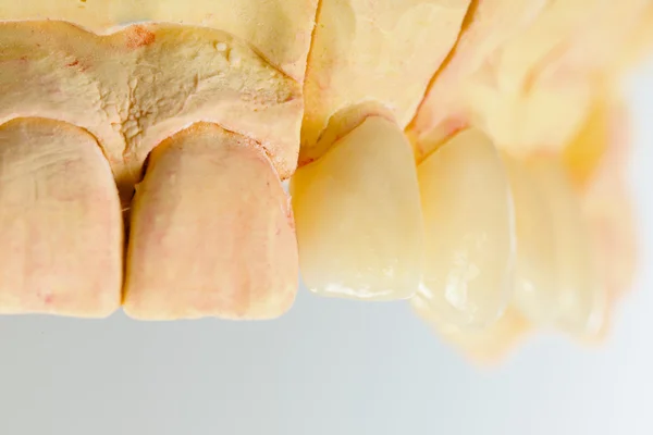 Pressed ceramic teeth — Stock Photo, Image