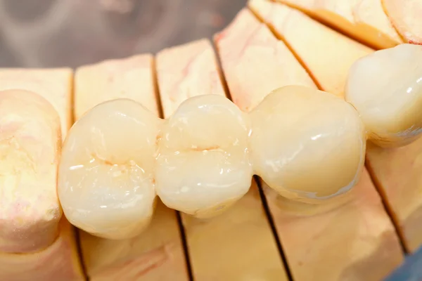 Denti ceramici pressati — Foto Stock