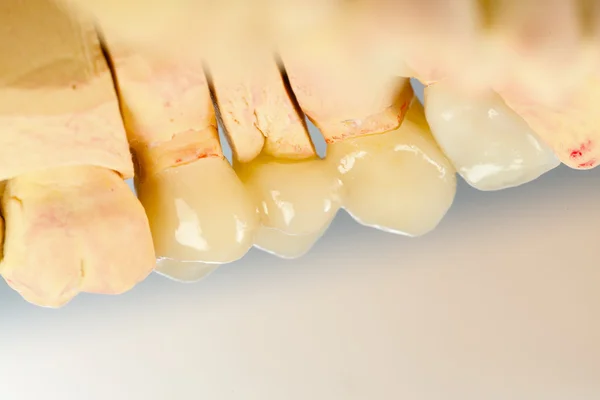 Denti ceramici pressati — Foto Stock