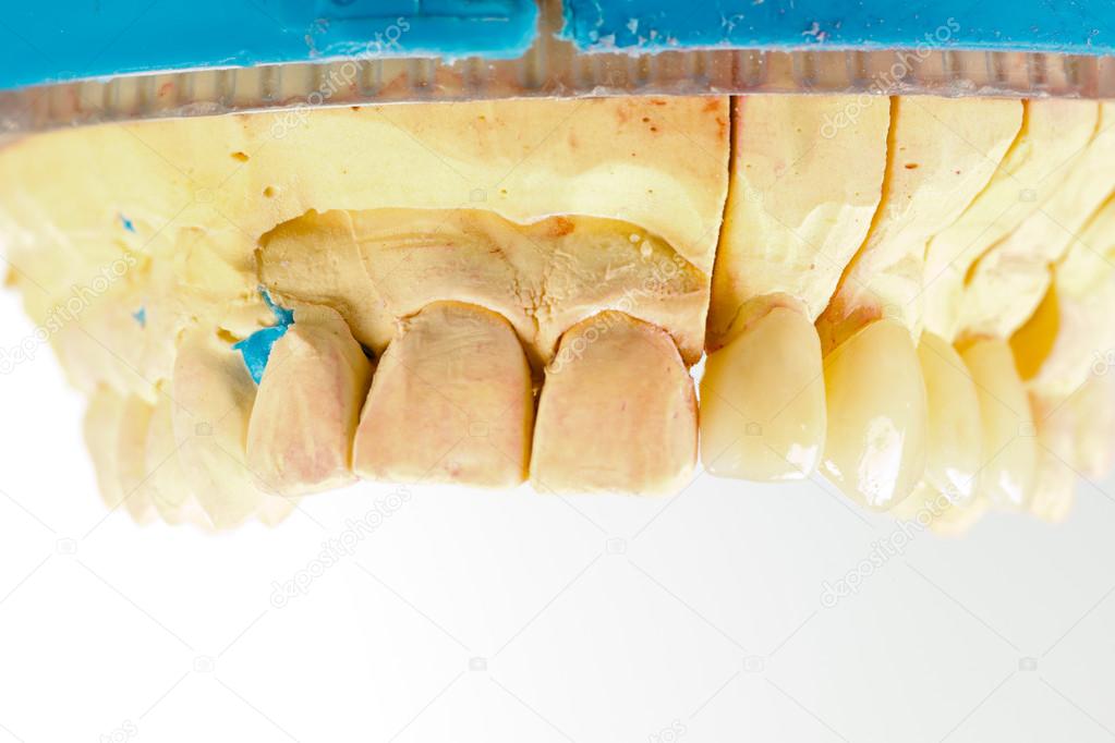 Pressed ceramic teeth