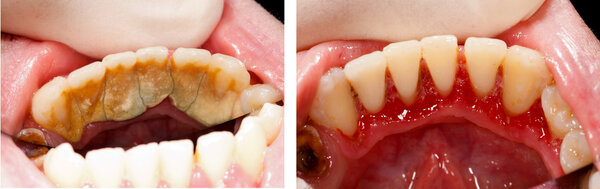 Massive tartar and treatment