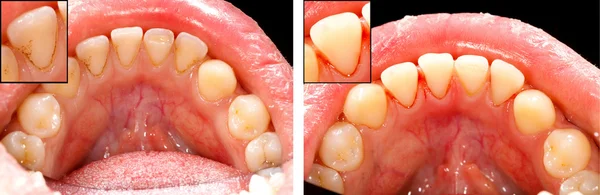 Limpiar los dientes antes y después —  Fotos de Stock