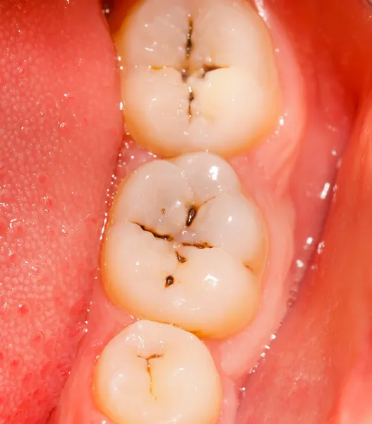 Cavity and teeth — Stock Photo, Image