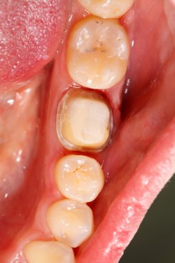 molar diş taç için hazırlanan