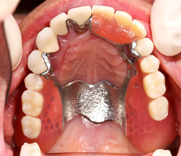 Prótese superior na boca — Fotografia de Stock