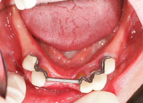 Crowns For Prosthesis In Mouth — Stock Photo, Image