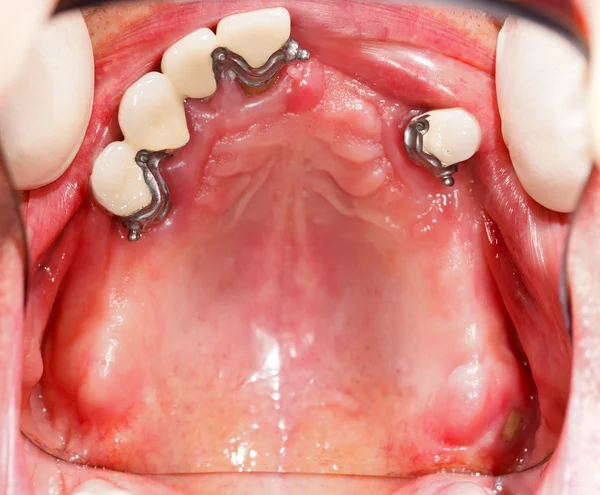 Crowns For Prosthesis In Mouth — Stock Photo, Image