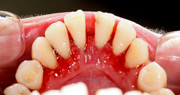 Na tandheelkundige behandeling — Stockfoto