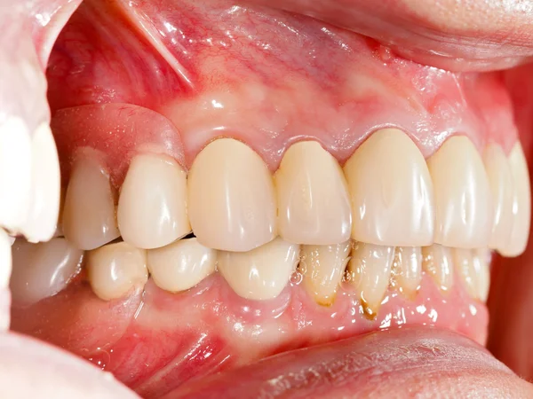 Dental Prosthetics — Stock Photo, Image