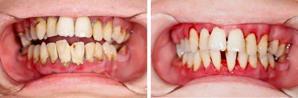 Prima e dopo il trattamento — Foto Stock