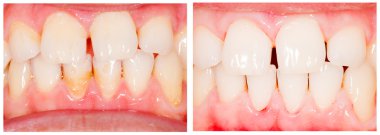 Teeth whitening clipart