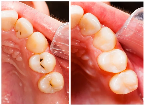 Caries Pictures Caries Stock Photos Images Depositphotos