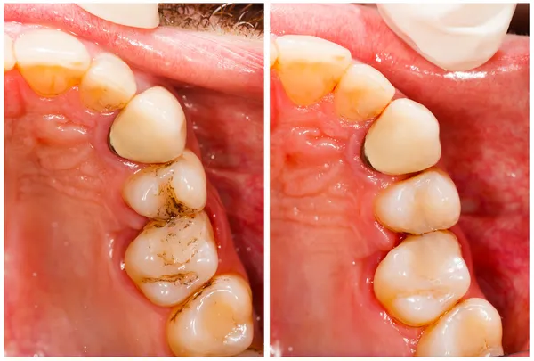 Trattamento dentale — Foto Stock