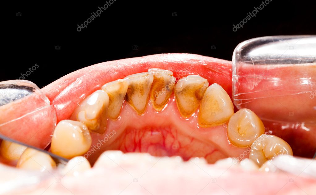 Plaque on Teeth