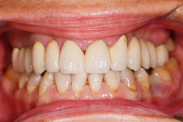 Porcelain teeth in human mouth — Stock Photo, Image