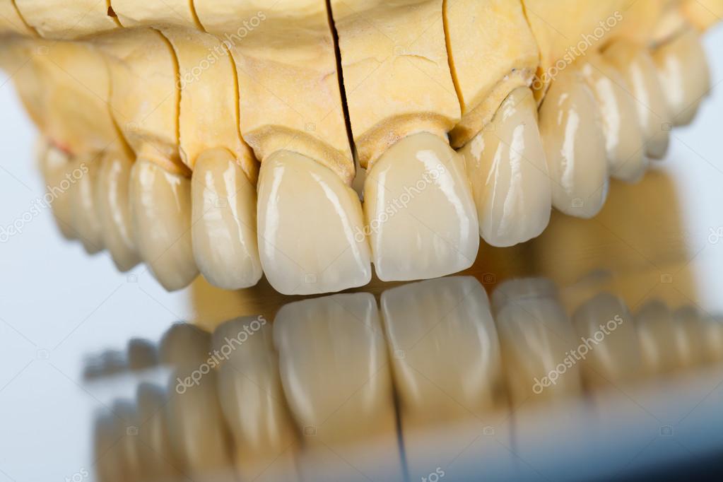 Ceramic teeth dental bridge Stock Photo by ©Lighthunter 29225587
