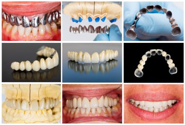 Technical steps of dental bridge clipart