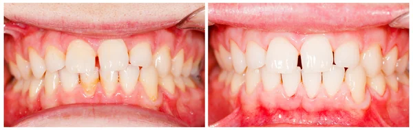 Antes e depois do tratamento — Fotografia de Stock