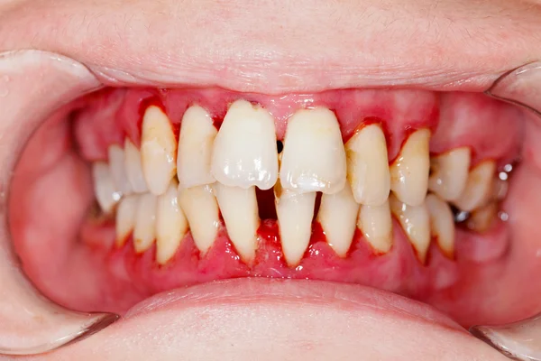 Después del tratamiento dental — Foto de Stock