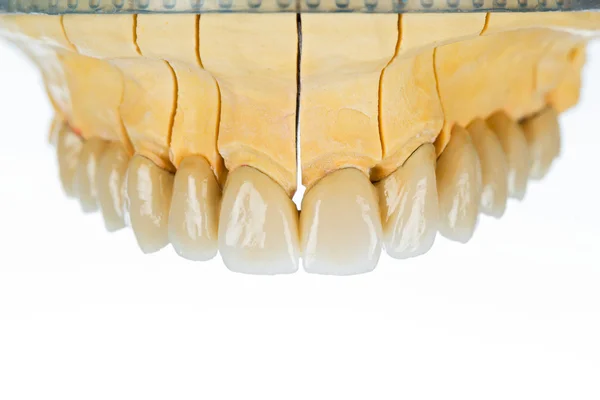 Denti in ceramica - ponte dentale — Foto Stock