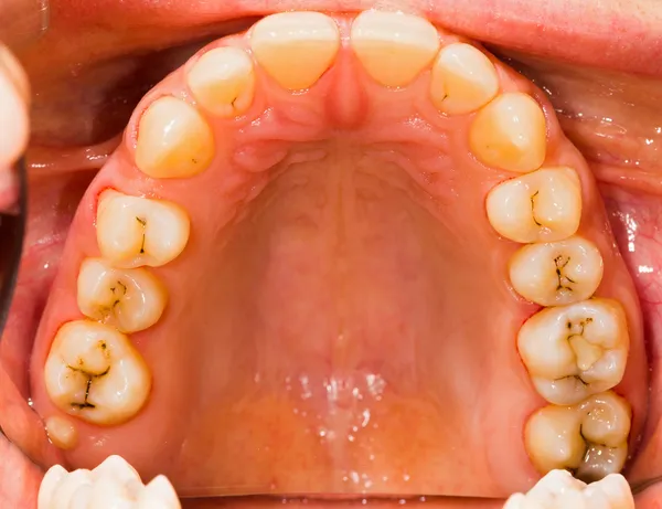 Dentadura do paciente — Fotografia de Stock