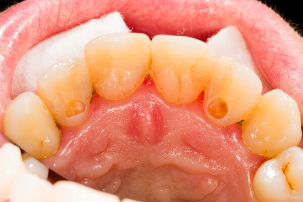 Dental pulp treatment