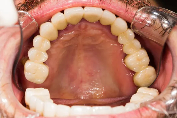 Coroas e pontes dentárias — Fotografia de Stock