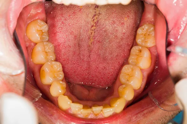 Dentadura inferior — Foto de Stock