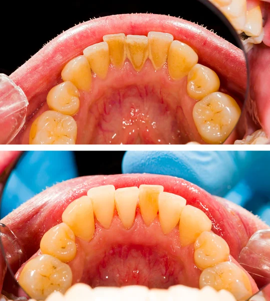 Fogkő-eltávolítás előtt — Stock Fotó