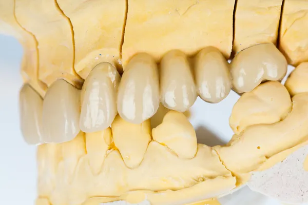 Denti in ceramica - ponte dentale — Foto Stock