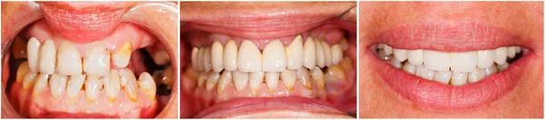 Зубы до и после лечения — стоковое фото