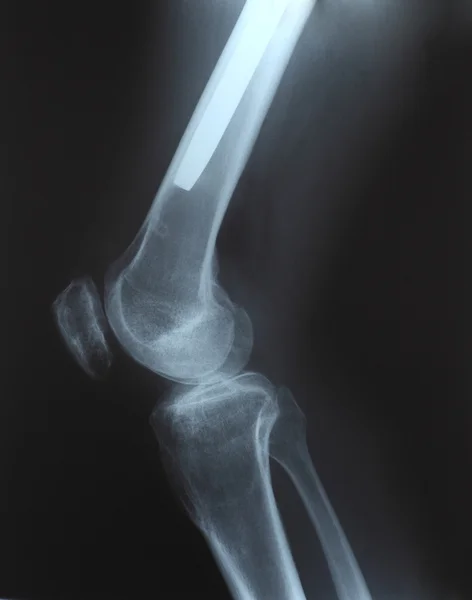 Radiografia de um osso de fêmur Kunstcher intramedular — Fotografia de Stock