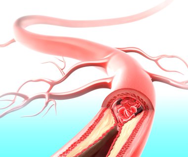 Atherosclerosis in artery caused by cholesterol plaque clipart