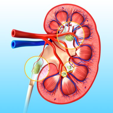 Kidney stone anatomy clipart