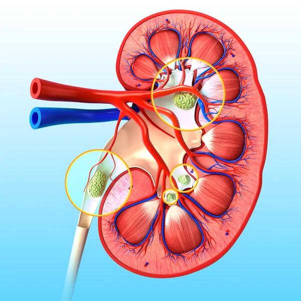 Kidney stone anatomy — Stock Photo, Image