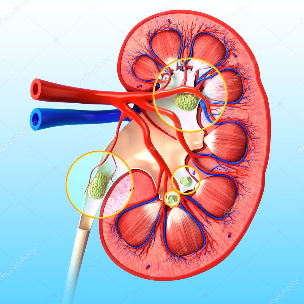 3d rendered illustration of kidney stone anatomy