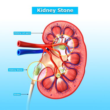 böbrek taşı anatomisi