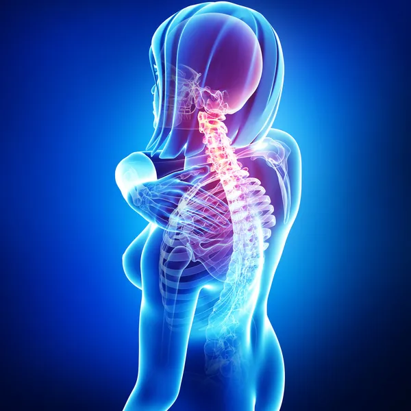 X-ray of neck pain female — Stock Photo, Image