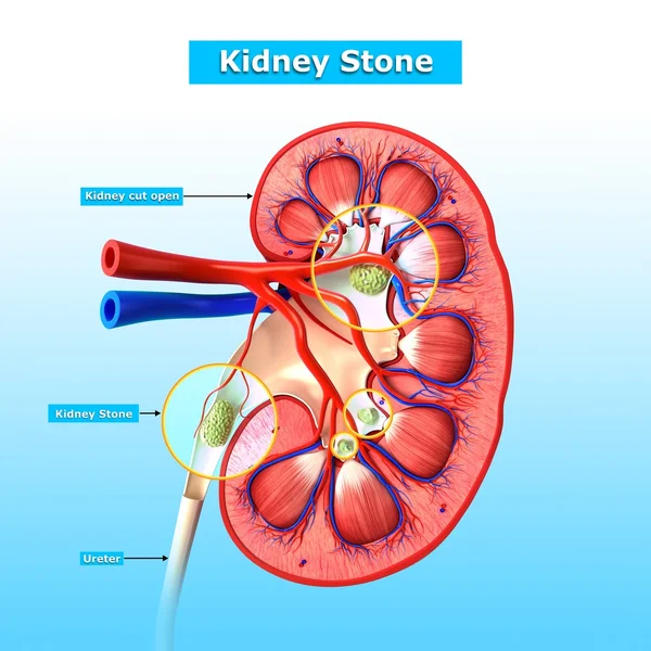 Anatomy of kidney stone — Stock Photo, Image