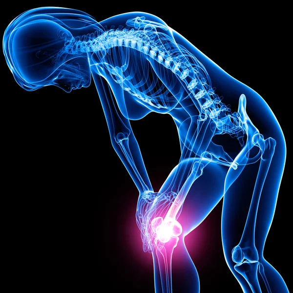 女性膝关节疼痛 — 图库照片