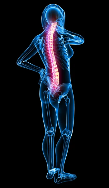 Kobieta kręgosłupa ból x-ray anatomii — Zdjęcie stockowe
