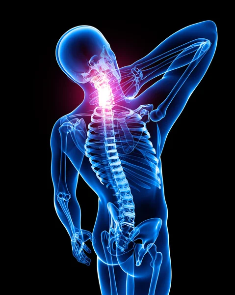 X 射线的脊椎疼痛 — 图库照片