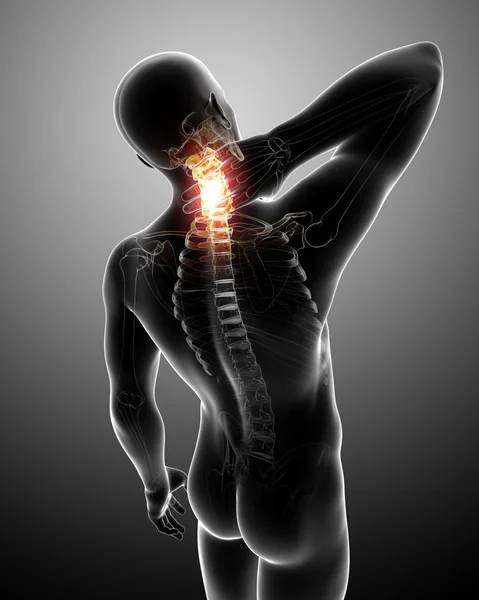 X-ray of spine pain — Stock Photo, Image